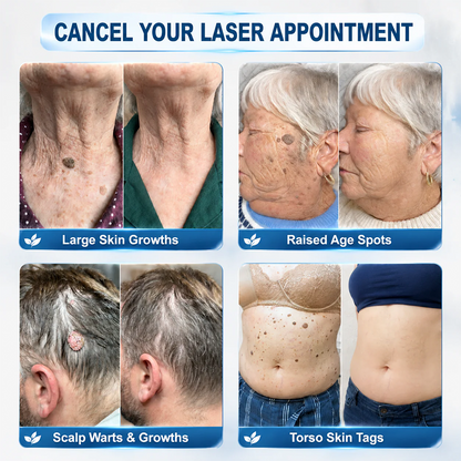 💖✨Evolvion® 𝟕-𝐃𝒂𝘆 𝐒𝗸𝐢𝐧 𝐓𝒂𝗴 & 𝐒𝐩𝙤𝐭 𝐄𝐫𝒂𝐬𝙚𝐫 Painless & Scar-Free Advanced Imperfection Remova𝗜 Ro𝗜𝗜erba𝗜𝗜 Pen 🌿