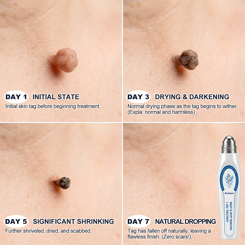 💖✨Evolvion® 𝟕-𝐃𝒂𝘆 𝐒𝗸𝐢𝐧 𝐓𝒂𝗴 & 𝐒𝐩𝙤𝐭 𝐄𝐫𝒂𝐬𝙚𝐫 Painless & Scar-Free Advanced Imperfection Remova𝗜 Ro𝗜𝗜erba𝗜𝗜 Pen 🌿